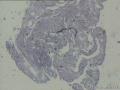 肠系膜，肠浆膜多发小结节图6