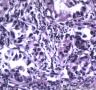胃溃疡伴腺上皮细胞非典型增生图13