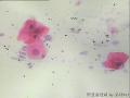 宫颈 传统涂片 H-E染色 患者45岁 月经规律图6