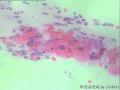宫颈 传统涂片 H-E染色 患者45岁 月经规律图10