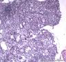 胃溃疡伴腺上皮细胞非典型增生图2