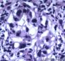 胃溃疡伴腺上皮细胞非典型增生图16