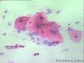 宫颈 传统涂片 H-E染色 患者45岁 月经规律图8