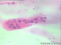 宫颈 传统涂片 H-E染色 患者57岁 是否绝经未知图4