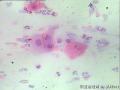 宫颈 传统涂片 H-E染色 患者45岁 月经规律图23