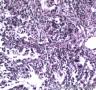 胃溃疡伴腺上皮细胞非典型增生图4