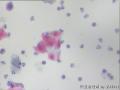 宫颈TCT 患者55岁 绝经1年图7