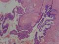 阑尾粘液性腺癌图2