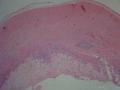 阑尾粘液性腺癌图12