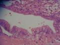 阑尾粘液性腺癌图16