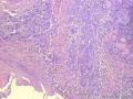 经典病例学习-甲状腺乳头状癌图1