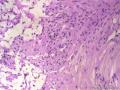 经典病例学习-丛状神经鞘瘤图19