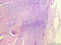 经典病例学习-甲状腺乳头状癌图4