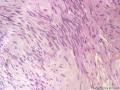 经典病例学习-丛状神经鞘瘤图16