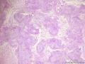 经典病例学习-丛状神经鞘瘤图7