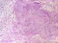 经典病例学习-丛状神经鞘瘤图11