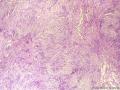 经典病例学习-丛状神经鞘瘤图15
