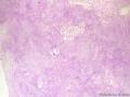经典病例学习-丛状神经鞘瘤图5