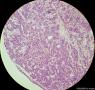 少见的子宫颈鳞状细胞癌类型（女，43岁）图7
