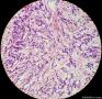 少见的子宫颈鳞状细胞癌类型（女，43岁）图10