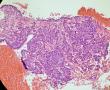 少见的子宫颈鳞状细胞癌类型（女，43岁）图17