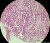 少见的子宫颈鳞状细胞癌类型（女，43岁）图24