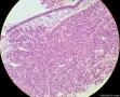 少见的子宫颈鳞状细胞癌类型（女，43岁）图5