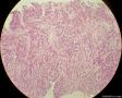 少见的子宫颈鳞状细胞癌类型（女，43岁）图22
