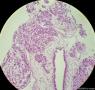 少见的子宫颈鳞状细胞癌类型（女，43岁）图3