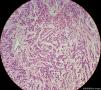 少见的子宫颈鳞状细胞癌类型（女，43岁）图23