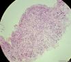 少见的子宫颈鳞状细胞癌类型（女，43岁）图11