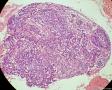 少见的子宫颈鳞状细胞癌类型（女，43岁）图16