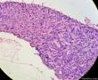 少见的子宫颈鳞状细胞癌类型（女，43岁）图15