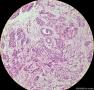 少见的子宫颈鳞状细胞癌类型（女，43岁）图2