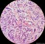 少见的子宫颈鳞状细胞癌类型（女，43岁）图14