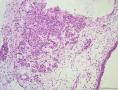 少见的子宫颈鳞状细胞癌类型（女，43岁）图6