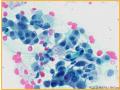 UPMC Cytology Case 03 - LUNG EBUS FNA图7