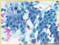 UPMC Cytology Case 03 - LUNG EBUS FNA图8