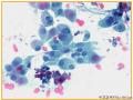 UPMC Cytology Case 03 - LUNG EBUS FNA图10