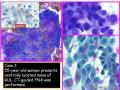 UPMC Cytology Case 03 - LUNG EBUS FNA图1