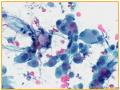 UPMC Cytology Case 03 - LUNG EBUS FNA图9
