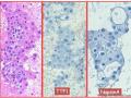 UPMC Cytology Case 03 - LUNG EBUS FNA图11