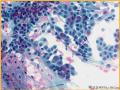 UPMC Cytology Case 03 - LUNG EBUS FNA图6