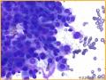 UPMC Cytology Case 03 - LUNG EBUS FNA图5