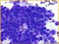 UPMC Cytology Case 03 - LUNG EBUS FNA图4