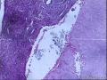 子宫肌壁间肿物图1