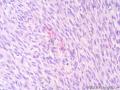 经典病例学习-高分化纤维肉瘤图12