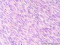 经典病例学习-高分化纤维肉瘤图14