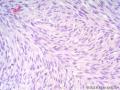 经典病例学习-高分化纤维肉瘤图7