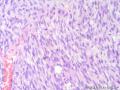 经典病例学习-高分化纤维肉瘤图11